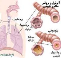 پنومونی در اطفال